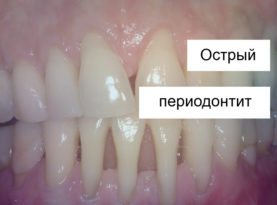 Острая форма периодонтита