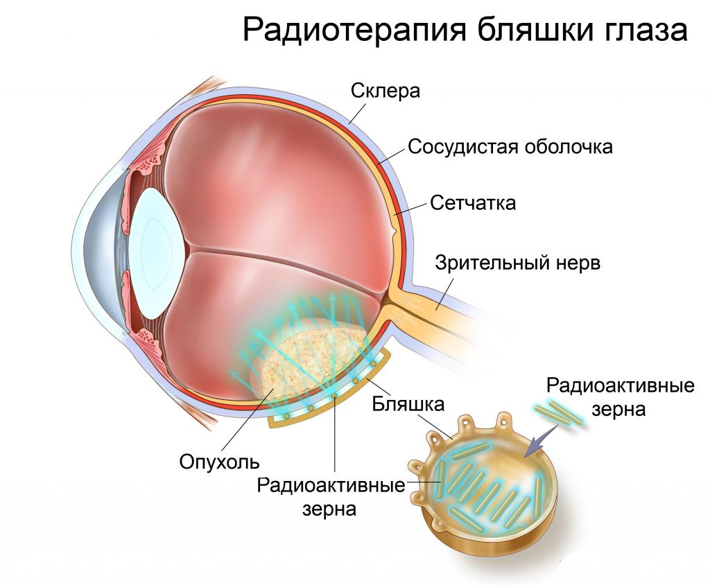 Внутренняя радиотерапия