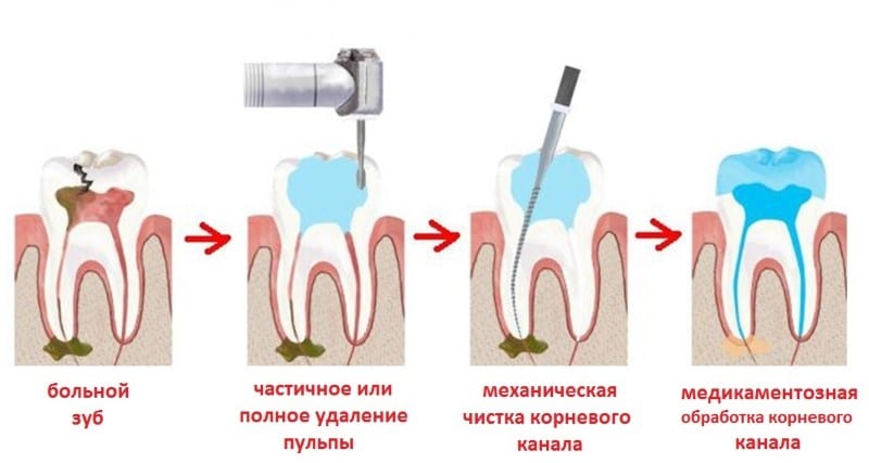 Лечение пульпита