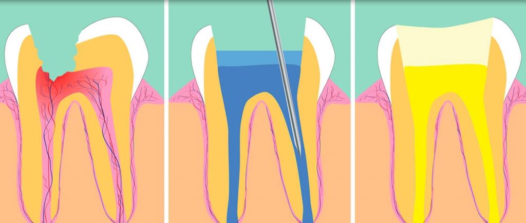 Лечение корневых каналов