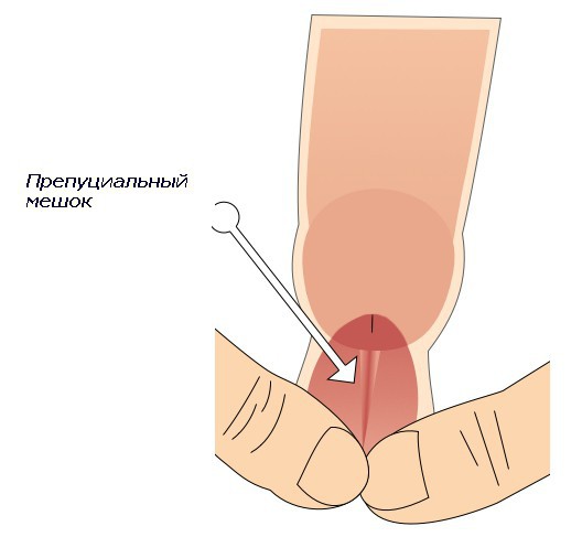 препуциальный мешок у мужчин фото