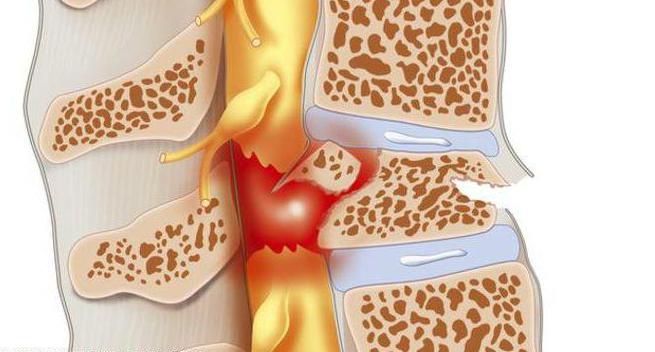 болезнь спины остеохондроз