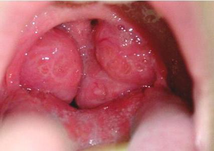 криотерапия миндалин противопоказания