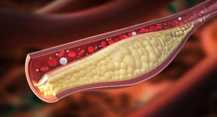 Бляшки на стенках сосудов
