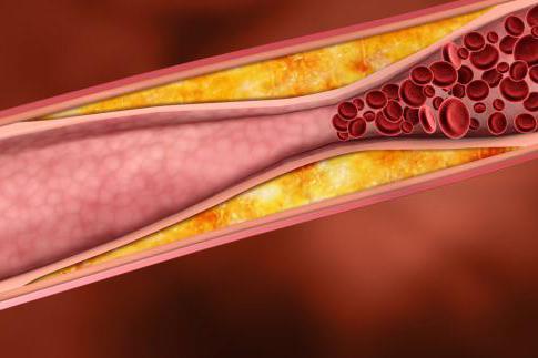 Бляшки в сосудах шейного отдела