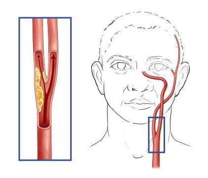 левая общая сонная артерия