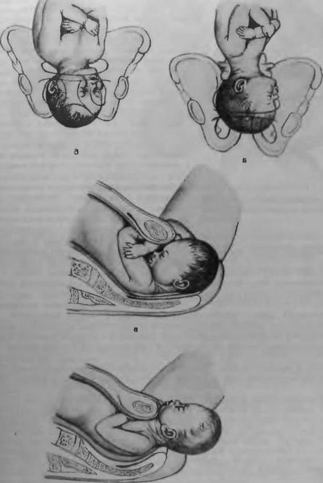 дицевое предлежание плода последствия