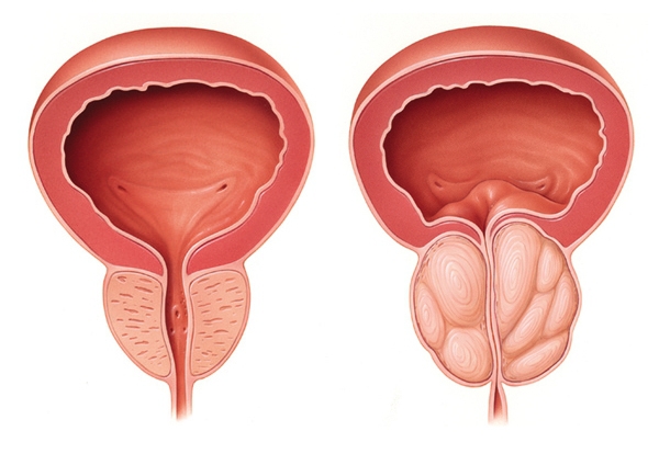 Киста простаты