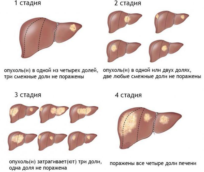 последняя стадия рака печени