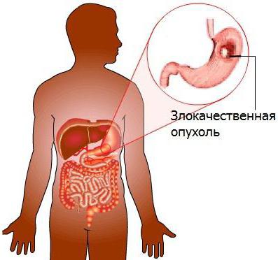 последняя стадия рака печени симптомы