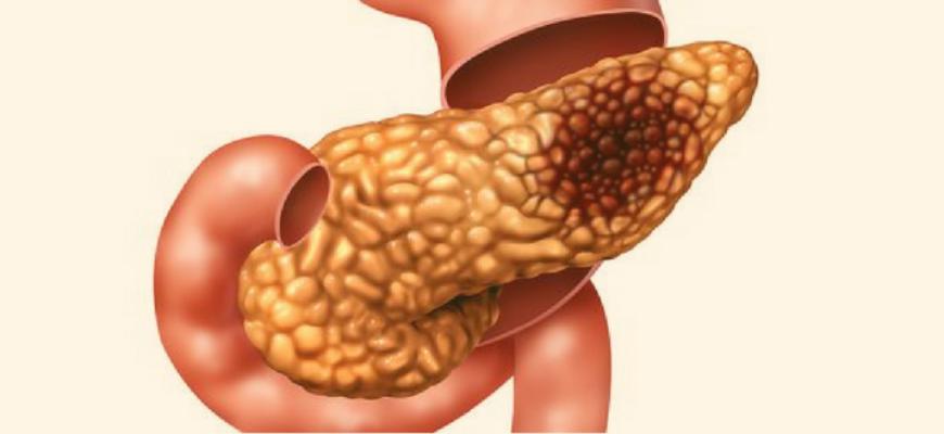 Панкреатит причины симптомы лечение