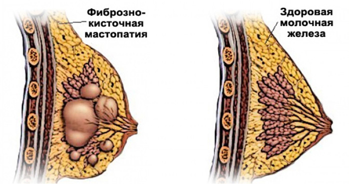 Фиброзно-кистозная мастопатия