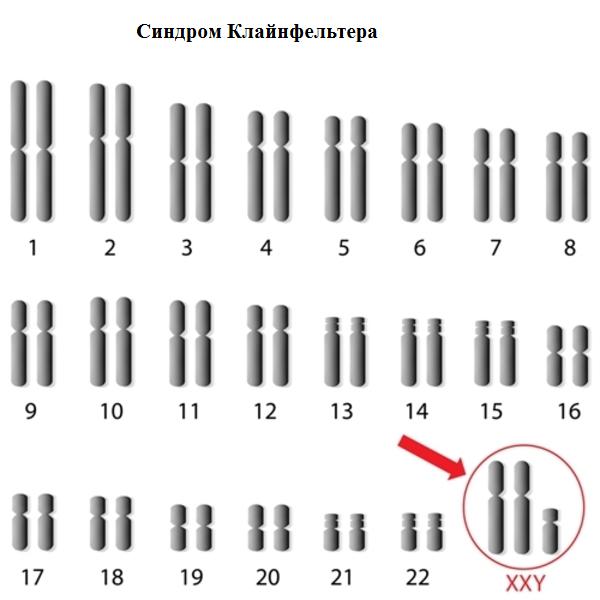 Синдром Клайнфельтера