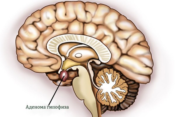 аденома гипофиза головного мозга что это такое