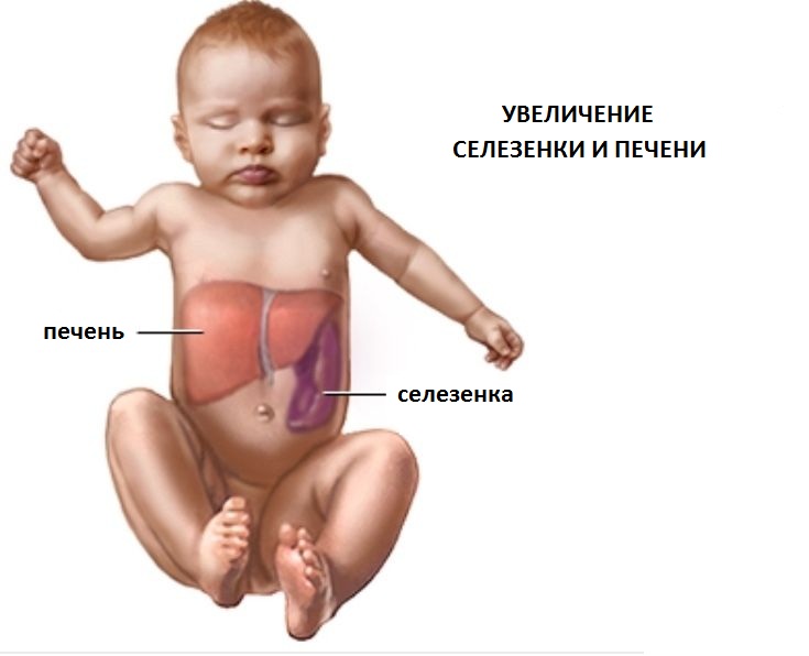 болезнь гоше лечение препараты