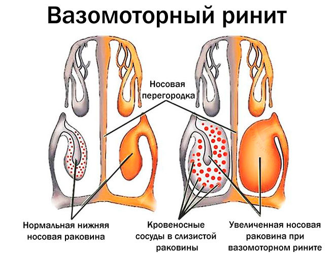 Вазомоторный ринит