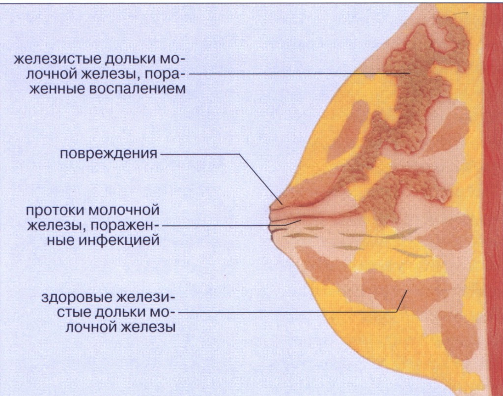 Мастит молочной железы