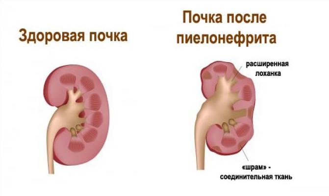 Здоровая и больная почка