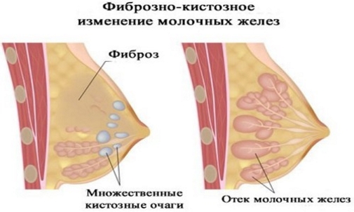 Изменения в молочной железе