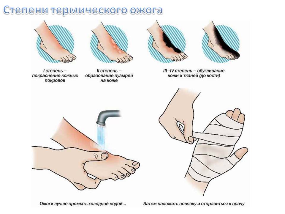 Степени термического ожога