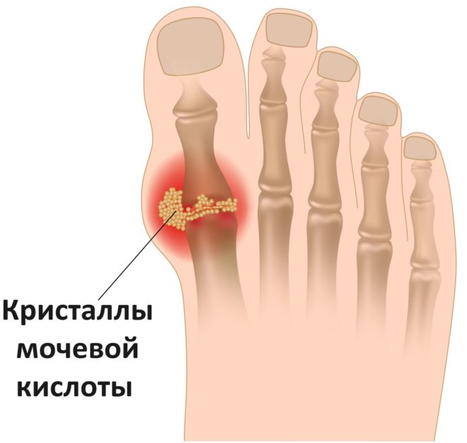 Кристаллы мочевой кислоты