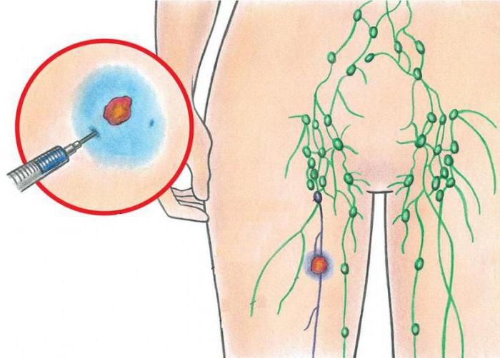 воспаление паховых лимфоузлов у женщин
