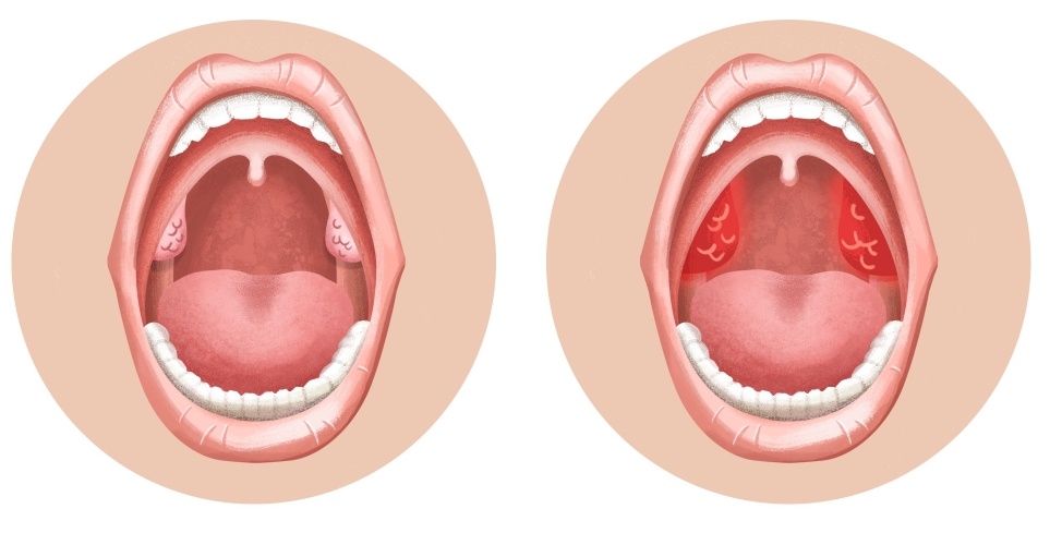 симптомы тонзиллита у взрослых