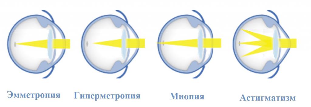 рефракция офтальмология