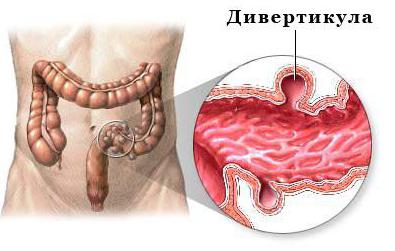 дивертикулез кишечника лечение диета 