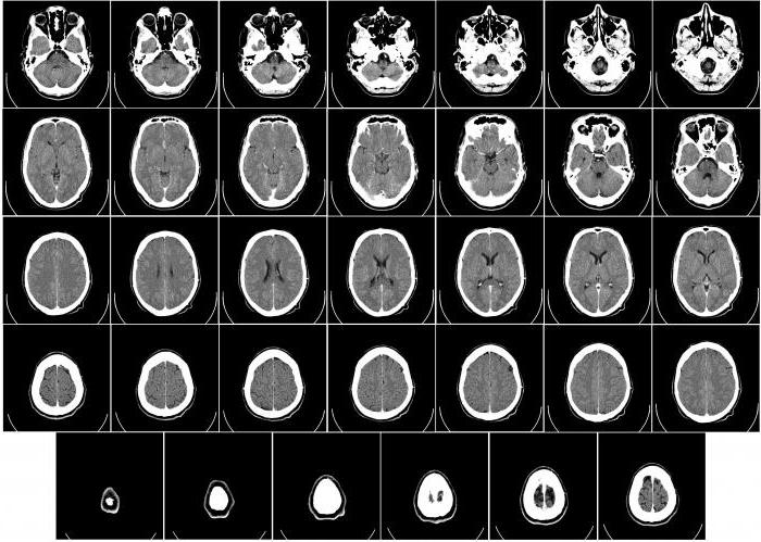  снимки мрт головного мозга