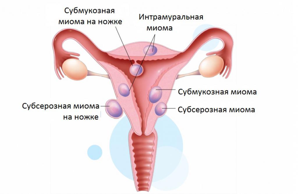 интрамуральная миома