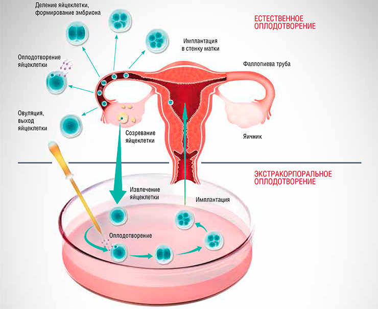 исскувственное оплодоьворение