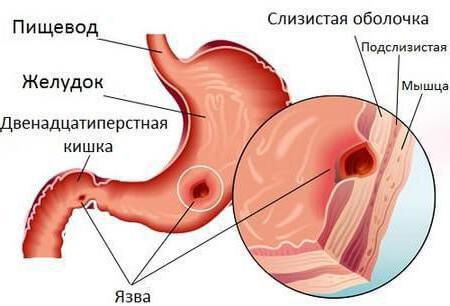 язвенный пилородуоденальный стеноз