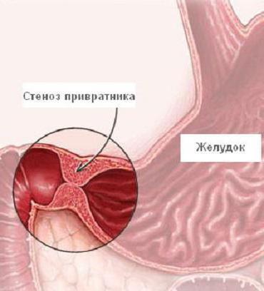 пилородуоденальный стеноз диагностика