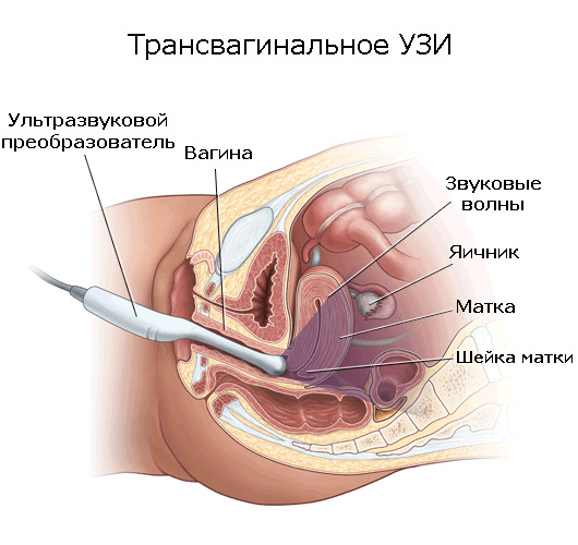 трансвагинальное узи