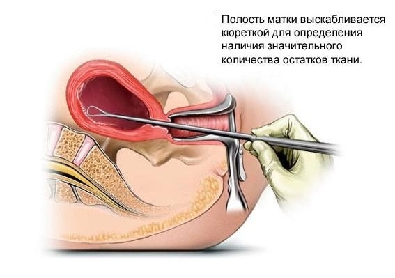 выскабливание полости матки