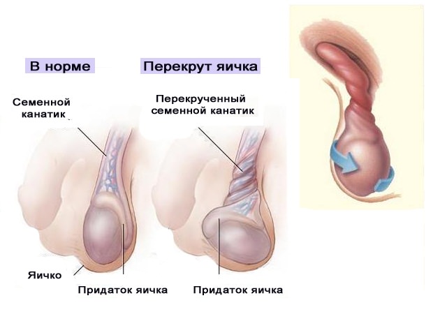 перекрут яичка