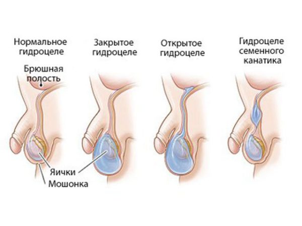 гидроцеле яичка