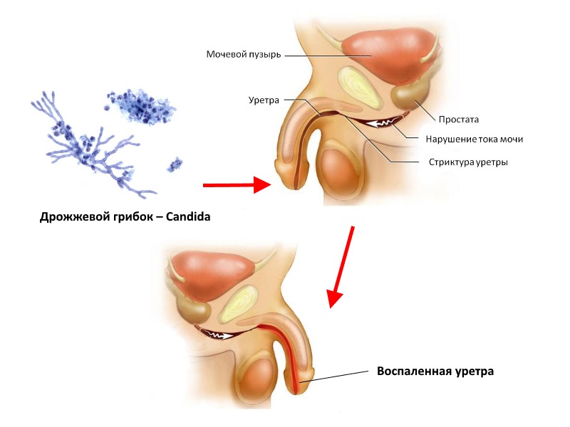 уретрит у мужчин