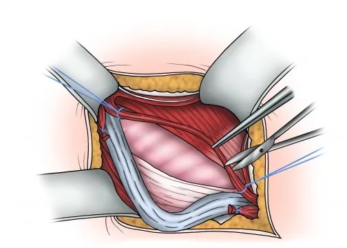 Удаление грыжи