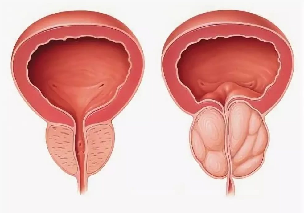 Киста простаты