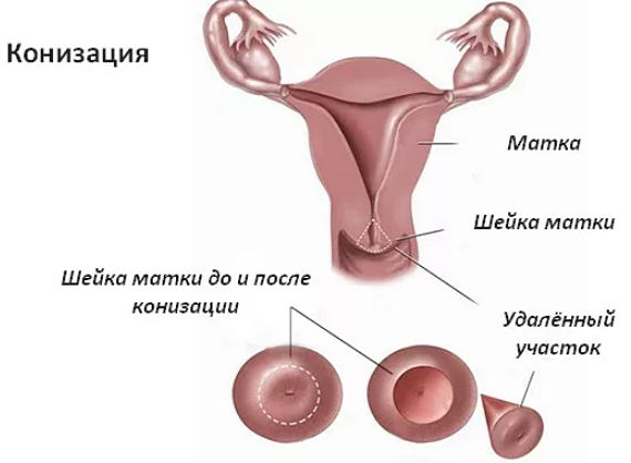 шейка матки после конизации фото