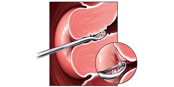 бужирование цервикального канала 