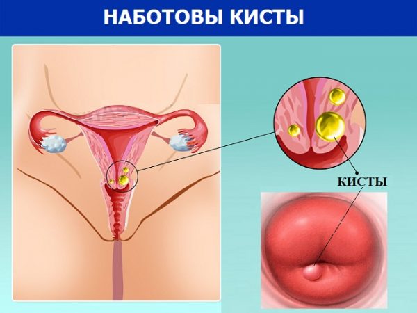 киста шейки матки