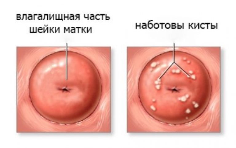 удаление кисты на шейке матки