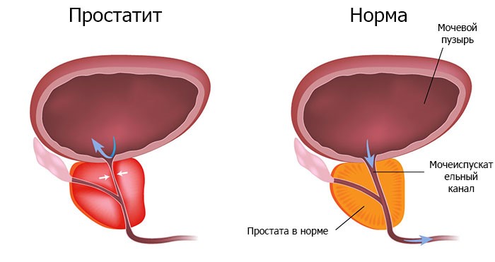 воспаление простаты 