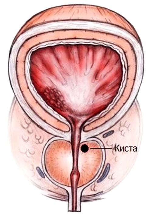 киста простаты 