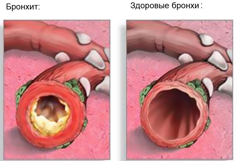 хронический бронхит обострение