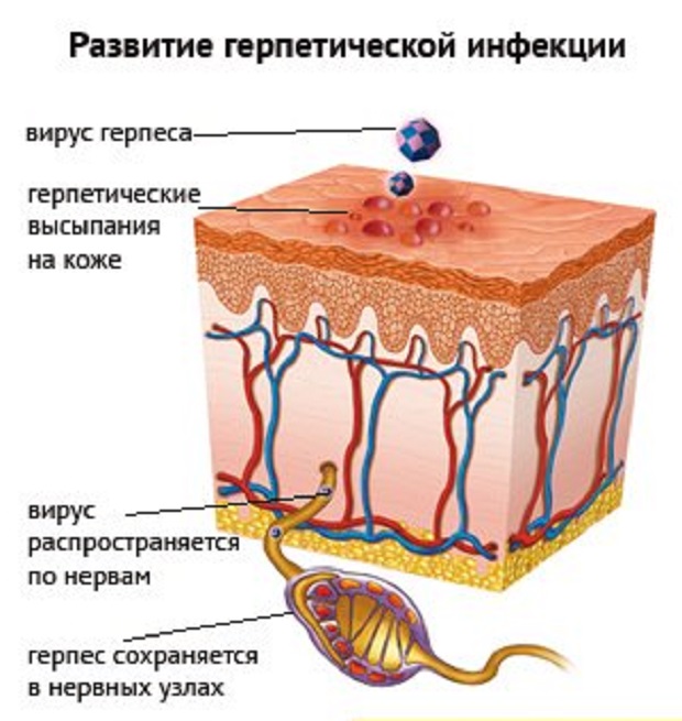 Вагинальный герпес у женщин