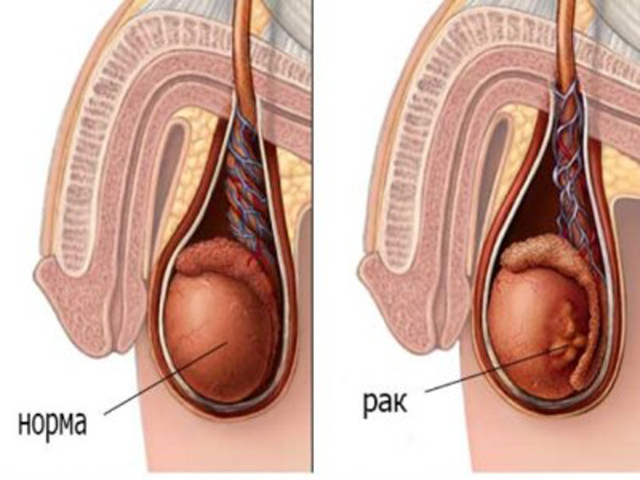 Этапы развития рака яичек